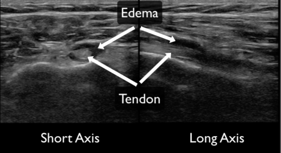 Figure 16 - tendonitis with edema short and long copy.jpg